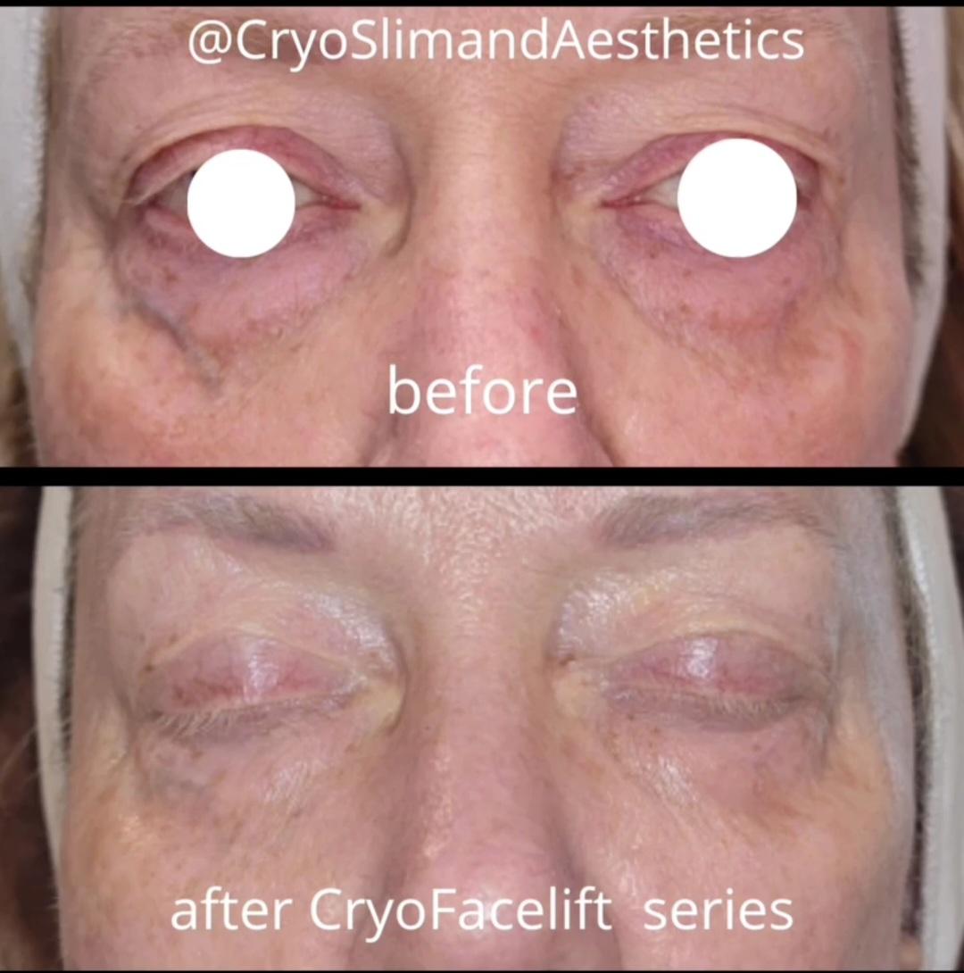 CryoSlim & Aesthetics — recovery studio